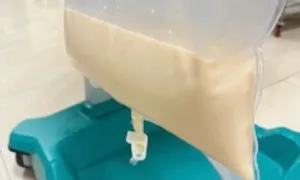 Mỡ máu tăng 80 lần, huyết tương trắng đục như sữa Mỡ máu tăng 80 lần, huyết tương trắng đục như sữa